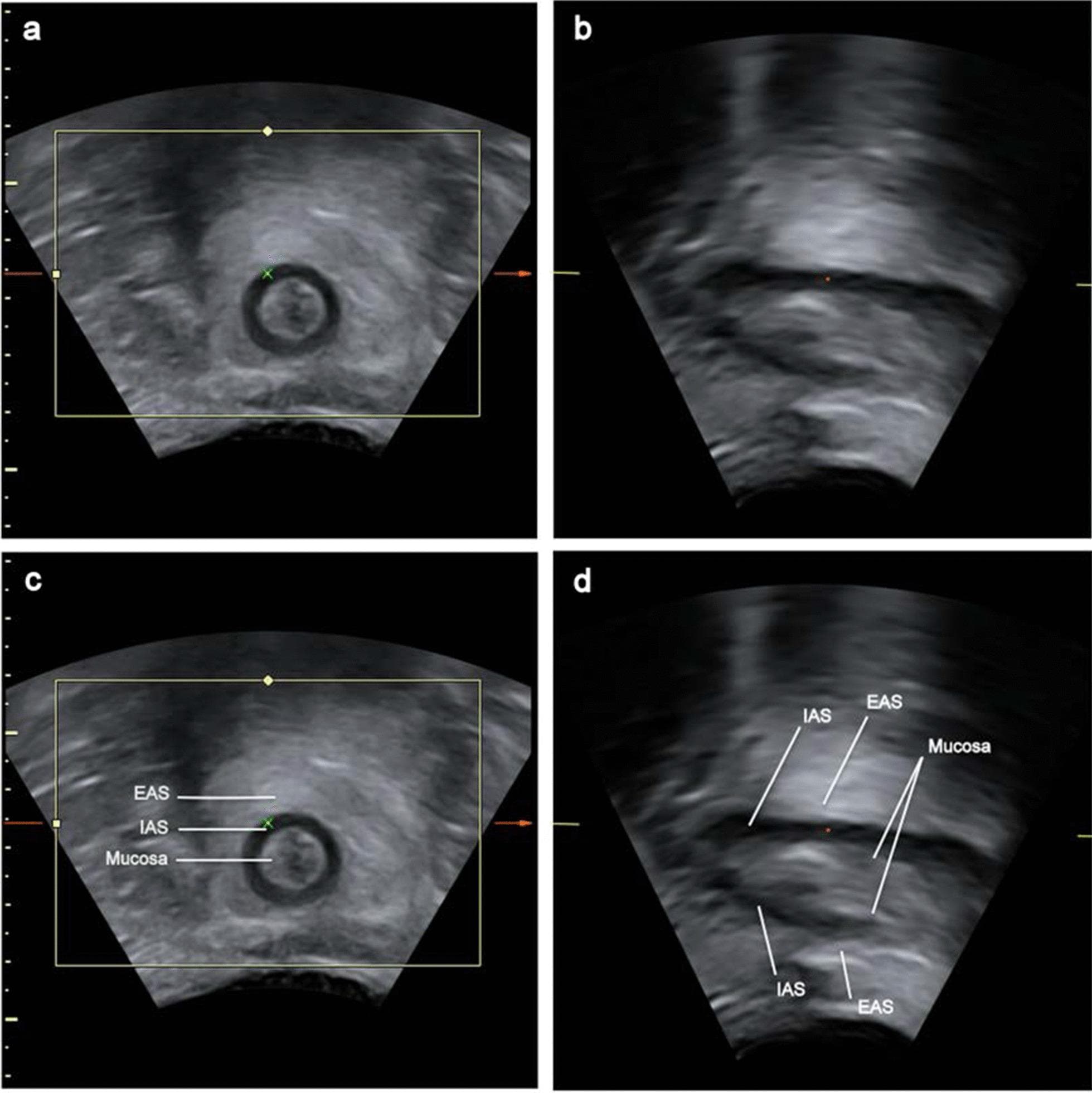 This set of diagnostic images shows perianal ultrasound (PAUS) views of the anal canal at rest. Images (a) and (c) display the coronal plane, while (b) and (d) display the midsagittal plane. In the coronal views, the anal canal is seen in cross-section with concentric layers: a central hypoechoic lumen representing the mucosa, surrounded by the dark, hypoechoic ring of the internal anal sphincter (IAS), which is further enclosed by the relatively hyperechoic external anal sphincter (EAS). In the midsagittal views, the longitudinal anatomy of the canal is visualized, showing the mucosa as a thin echogenic line, the IAS as a hypoechoic band running parallel to the canal, and the EAS as a thicker hyperechoic layer external to the IAS. Labels in (c) and (d) identify the IAS, EAS, and mucosa to highlight their relative spatial arrangement and echogenicity. These images are used in pelvic floor imaging to assess anorectal function, sphincter thickness, and anatomical integrity.
