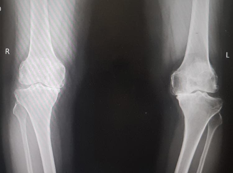 This diagnostic image is an anteroposterior (AP) standing radiograph of bilateral knee joints, demonstrating findings consistent with advanced primary osteoarthritis. The right knee shows significant medial compartment joint space narrowing, subchondral sclerosis, and marginal osteophyte formation at the femoral and tibial condyles. The left knee exhibits even more severe degenerative changes, characterized by near-total loss of medial joint space (bone-on-bone contact), pronounced subchondral sclerosis, large osteophytes, and visible bony irregularity indicating advanced articular cartilage destruction. There is evidence of varus malalignment, particularly on the left. This radiograph serves as a classic educational example of end-stage degenerative joint disease requiring clinical correlation for surgical planning, such as total knee arthroplasty. The image highlights key radiographic hallmarks of osteoarthritis: joint space narrowing, osteophytosis, subchondral sclerosis, and subchondral cyst formation.