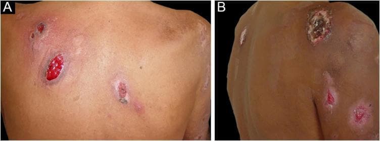 Two-panel clinical photograph demonstrating bullous pyoderma gangrenosum. Image A displays the posterior trunk (back) with multiple shallow ulcers characterized by a bright red, beefy granulating base and irregular, slightly elevated borders. The surrounding skin shows perilesional erythema and inflammation. Image B shows the upper limb with similar ulcerative lesions. A key diagnostic feature visible is the distinctive blue-gray or violaceous hue at the ulcer margins. The lesions vary in appearance from active erosions with red bases to ones with dark, hemorrhagic crusting or scabbing. This presentation illustrates a neutrophilic dermatosis often associated with underlying systemic conditions such as hematologic malignancies or inflammatory bowel disease. The educational focus is on identifying the characteristic undermined, dusky borders and the progression from bullae to shallow ulcers typical of the bullous variant of pyoderma gangrenosum.