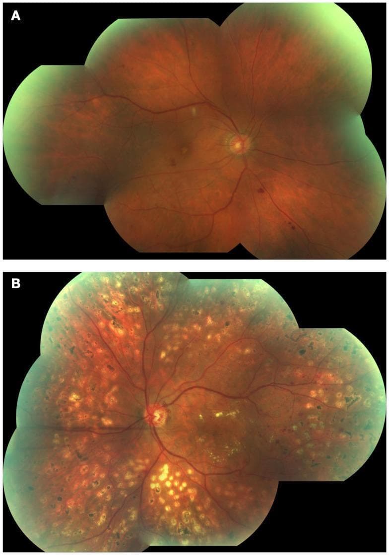 This clinical photograph shows a side-by-side comparison of two fundus images (A and B) illustrating the progression of diabetic retinopathy. Image A depicts Non-Proliferative Diabetic Retinopathy (NPDR), characterized by a relatively stable retinal vascular structure with early clinical signs, including isolated retinal hemorrhages and a distinct white cotton wool spot located superior to the macula. Image B illustrates Proliferative Diabetic Retinopathy (PDR), demonstrating advanced disease manifestations. Key visible features in Image B include extensive neovascularization (neovessels) originating from the optic disc, characterized by disorganized and atypical vascular branching. The retinal background in Image B shows widespread pathology with numerous yellow-white hard exudates and significant macular exudation, indicating a breakdown of the blood-retinal barrier and chronic ischemia. These images serve as an educational comparison between the non-proliferative stage and the high-risk proliferative stage of diabetic eye disease, highlighting diagnostic landmarks such as neovascularization and exudative changes.