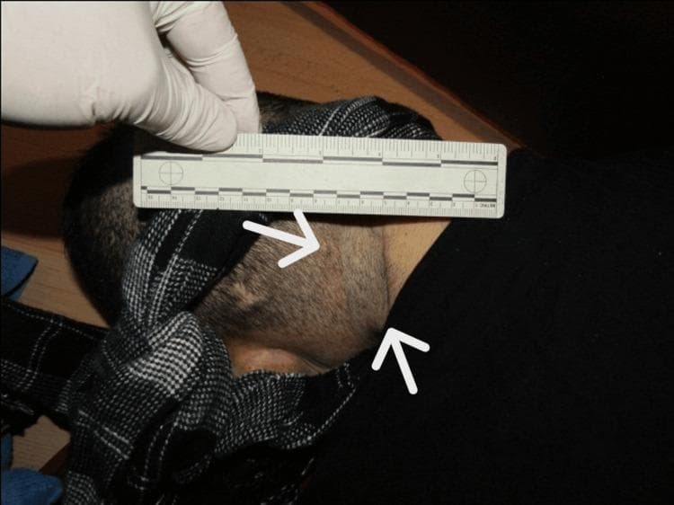This clinical photograph from a forensic pathology context demonstrates a ligature mark on the neck of a deceased individual. The image shows a well-defined, slightly depressed negative imprint on the upper neck, positioned above the level of the thyroid cartilage. The mark follows an oblique, rising course towards the posterior aspect of the neck, which is characteristic of suspension in hanging cases. White arrows highlight the location and trajectory of the furrow. A forensic ruler is held against the neck by a gloved hand to provide a scale for the width and positioning of the mark. The surrounding skin appears pale, and part of the head is covered by a patterned textile (scarf). This visual serves as an educational example of external findings in mechanical asphyxiation, specifically demonstrating the morphology and distribution of a ligature furrow used to distinguish between different types of neck constriction.
