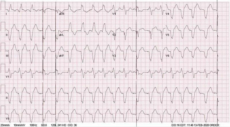 A standard 12-lead electrocardiogram (ECG) demonstrating a ventricular paced rhythm, consistent with Cardiac Resynchronization Therapy (CRT). The tracing shows a regular rhythm at a rate of approximately 111 beats per minute. Each QRS complex is preceded by a distinct, sharp vertical pacemaker spike, most visible in the inferior leads (II, III, aVF) and precordial leads (V1-V6). The QRS complexes are wide (prolonged duration) and exhibit a left bundle branch block-like morphology, common in biventricular pacing. There is an absence of discernible native P waves before the pacing spikes, suggesting either atrial pacing with a programmed AV delay or an underlying atrial arrhythmia like atrial fibrillation with a paced ventricular response. ST-segment and T-wave changes are present, which are secondary to the abnormal ventricular depolarization pattern. This ECG is a key diagnostic tool for evaluating pacemaker function and captured cardiac response in patients with heart failure and conduction system disease.
