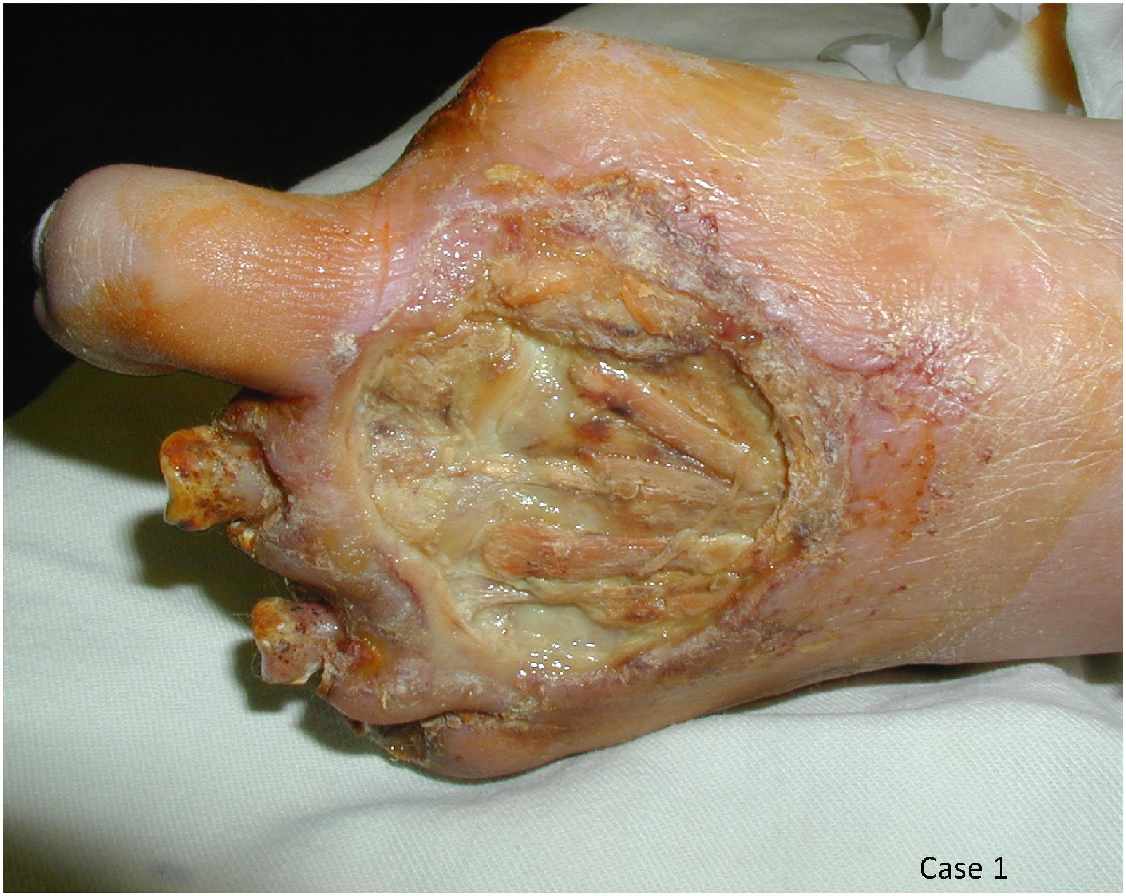 Clinical photograph of a left foot demonstrating severe ischemic complications and tissue loss associated with Buerger's disease (thromboangiitis obliterans) and superimposed atherosclerosis. The image shows a large, deep ulceration on the dorsal and lateral midfoot, exposing underlying extensor tendons, fascia, and subcutaneous tissue. The wound bed appears fibrinous with areas of moist slough. There is evidence of significant structural compromise: the second through fifth digits have undergone partial amputations, leaving irregular stubs with signs of necrosis and chronic scarring. The remaining first toe appears pale with dry, xerotic skin and thin epithelium. Surrounding skin on the midfoot and ankle exhibits varying degrees of erythema, pallor, and hyperkeratosis, indicative of chronic peripheral limb ischemia. This visual serves as a primary example of advanced peripheral arterial disease (PAD) in a patient with multi-decade smoking history and metabolic risk factors, illustrating the progression from digital ulcers to gangrene and auto-amputation.