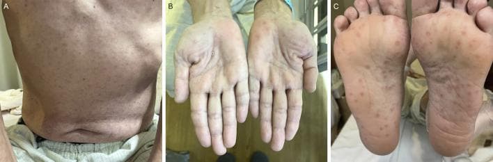 A clinical photograph series illustrating dermatological manifestations of secondary syphilis across three anatomical regions. Panel A shows the posterior trunk displaying a diffuse, symmetric, erythematous maculopapular rash. Panel B and C depict the bilateral palms and soles, respectively, featuring characteristic well-demarcated, rounded, erythematous to reddish-brown macules and papules. Some acral lesions exhibit subtle peripheral scaling, consistent with Biett's collarette. This classic 'copper-colored' rash distribution, specifically involving the palms and soles, is a pathognomonic clinical sign for secondary syphilis. The presentation highlights the generalized nature of the Treponema pallidum infection during the disseminated stage. This visual resource is intended for medical education regarding sexually transmitted infections and differential diagnosis of palmoplantar eruptions.