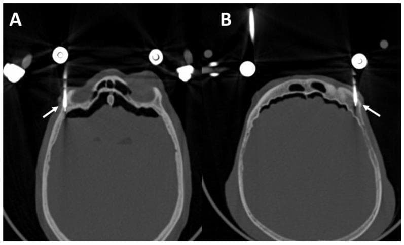 This diagnostic image consists of two axial computerized tomography (CT) scans (labeled A and B) of a human skull, demonstrating the surgical management of complex facial trauma, specifically a Le Fort III fracture. High-density, cylindrical metallic supraorbital pins are visualized (indicated by white arrows) inserted into the lateral third of the upper orbital margin. The pins are placed monocortically, providing external functional fixation (EFF) and stabilization of the fractured craniofacial segments. View A highlights a pin on the patient's right side, while View B demonstrates bilateral pin placement. The scans show the pins are positioned intraosseously, carefully avoiding penetration into the anterior cranial fossa to prevent intracranial complications. Significant bone discontinuity in the frontal and sinus regions is visible, consistent with the described fracture pattern. Streaking artifacts typical of metallic implants are present. This image serves as a clinical reference for optimal drilling angles and anatomical placement of external fixation pins in maxillofacial surgery.