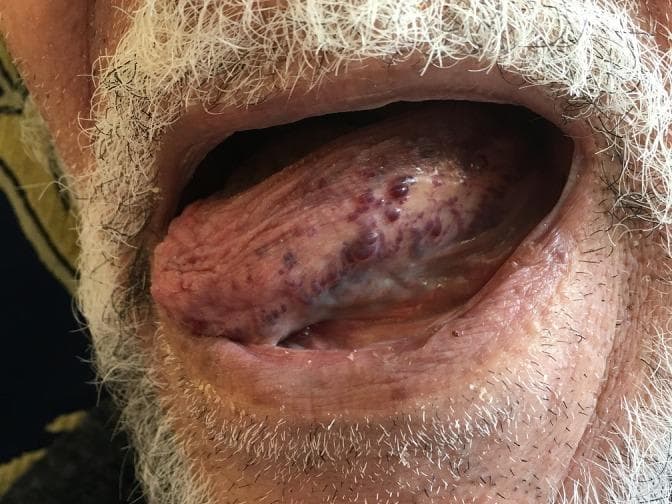 A clinical photograph of a human oral cavity showing the tongue protruding from the mouth. The tongue exhibits macroglossia (enlargement) and a highly irregular surface texture characterized by numerous clustered, small, dome-shaped papules or vesicles. These lesions vary in color from translucent to deep red and purple-blue, representing a 'frog-spawn' appearance typical of lymphangioma circumscriptum. This superficial lymphatic malformation displays intralesional hemorrhage, causing the darkened, hemorrhagic vesicles visible on the dorsal and lateral surfaces of the tongue. The surrounding lips and perioral skin, including the beard of an elderly male patient, appear unremarkable except for slight retraction to facilitate visualization of the lingual pathology. This image is an educational example of oral lymphatic malformations in a geriatric patient, highlighting the classic morphology of superficial circumscribed lymphangioma.