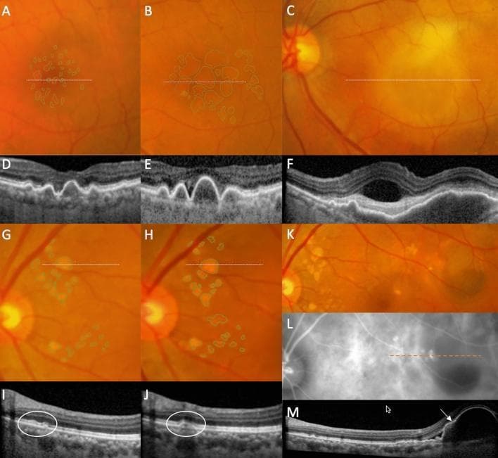 This composite diagnostic image illustrates the longitudinal progression of two subtypes of age-related macular degeneration (AMD): soft drusen (panels A–F) and pachydrusen (panels G–M), using color fundus photography (CFP), optical coherence tomography (OCT), and indocyanine green angiography (ICGA). Panels A–C show the enlargement and confluence of soft drusen over three years, leading to incident exudative macular neovascularization (MNV). Corresponding OCT scans (D–F) reveal an increase in drusen height followed by the development of subretinal fluid, subretinal hyperreflective material (SHRM), and an irregular pigment epithelial detachment (PED). Panels G–K demonstrate pachydrusen progression, characterized by ovoid, well-defined lesions. Panel K shows the development of a hemorrhagic PED, which ICGA (L) confirms as polypoidal choroidal vasculopathy (PCV). The final OCT (M) highlights a polypoidal lesion with associated serous detachment. This comparison highlights the distinct morphological pathways toward advanced exudative disease, emphasizing the role of multimodal imaging in monitoring choroidal vascular changes and drusen dynamics in retinal pathology.