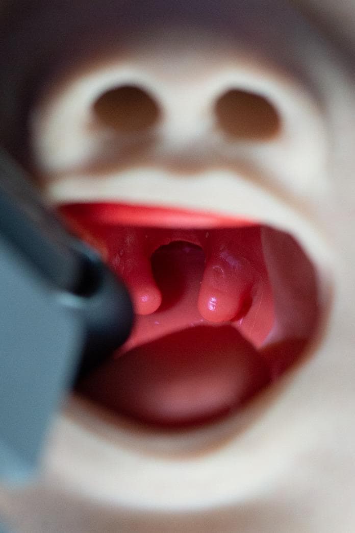 A clinical photograph of a specialized airway manikin representing the oropharyngeal anatomy of an infant with Pierre Robin Sequence (PRS). The image provides a direct view into the oral cavity, highlighting several key congenital anomalies. Centrally, a significant midline cleft palate is visible, characterized by the failure of the palatal shelves to fuse. Suspended from the margins of the soft palate is a prominent bifid uvula, which appears as two distinct, fleshy lobes. The external facial features of the manikin also demonstrate micrognathia (a small, recessed mandible), which is a hallmark of PRS and contributes to glossoptosis (posterior displacement of the tongue), potentially complicating airway management. This educational tool is used to simulate difficult pediatric intubation scenarios, allowing clinicians to practice identifying and navigating anatomical obstructions related to craniofacial microsomia and palatal defects. The image is highly relevant for training in neonatology, anesthesiology, and pediatric otolaryngology.