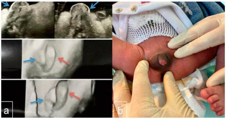 This figure presents a clinical case of ambiguous genitalia through prenatal ultrasound and postnatal photography. Panel (a) contains four frames of prenatal ultrasound (2D and 3D) from the second trimester. It highlights a labial/scrotum-like formation (indicated by blue arrows) and a prominent median phallus-like structure (indicated by red arrows), illustrating the diagnostic difficulty in fetal gender assignment. Panel (b) is a clinical photograph of the neonate at 24 hours of age. The image shows the perineal region with gloved hands retracting the skin to reveal a small phallus (1.4 cm) with a hyperpigmented base and a blind dimple on the glans. The visible morphology is consistent with Prader stage 4 virilization, showing significant clitoral enlargement or a microphallus with a ventrally opening urethra (hypospadias) at the base. The presentation is typical for Disorders of Sex Development (DSD), such as 45,X/46,XY mosaicism. This material serves as an educational resource for prenatal diagnosis, neonatal physical examination, and the classification of genital ambiguity.