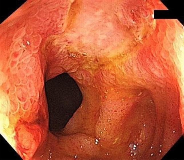 This diagnostic endoscopic image (colonoscopy) showcases the terminal ileum in a patient with inflammatory bowel disease-unclassified (IBDU). The mucosal surface exhibits significant pathological changes, including multiple small, round ulcerations and diffuse erythema. The mucosa appears predominantly pinkish-red with yellowish patches of exudate or discoloration. Evidence of chronic inflammation and repair is visible through irregular scar tissue and a distorted mucosal texture. Notably, the ileal lumen is visibly narrowed, indicating a pathological stricture that alters its normal circular shape. These features—ulceration, scarring, and luminal narrowing—are key endoscopic indicators of active and chronic intestinal inflammation, often necessitating interventions like endoscopic balloon dilation (EBD). The image provides a high-level educational example of ileal stricture morphology and mucosal remodeling in the context of chronic gastrointestinal disorders.
