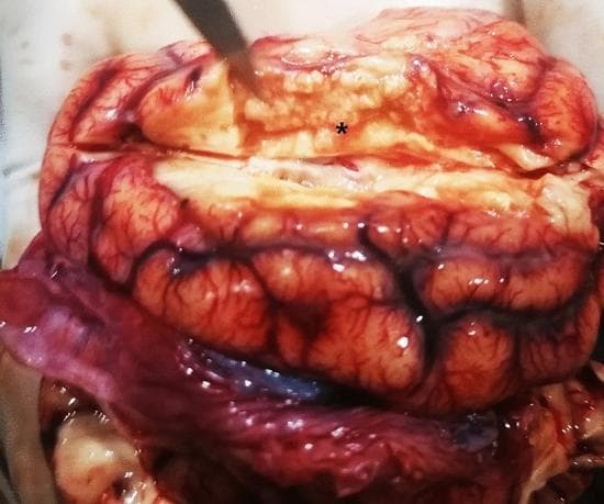 This clinical photograph shows a gross pathological specimen of a brain during necropsy. The primary finding is a focal area of liquefactive necrosis in the right cerebral hemisphere, marked by an asterisk (*). This necrotic region appears as a pale, yellowish-white, and softened area of tissue loss measuring approximately 2 cm x 0.5 cm x 1 cm. Adjacent to the necrosis, there is prominent meningeal congestion characterized by diffuse erythema and engorged vessels following the sulci and gyri. The underlying cortical tissue shows signs of hyperemia. The visual evidence supports a diagnosis of severe central nervous system inflammation or infection leading to tissue softening and degradation, typical of liquefactive processes in neural tissue. This specimen demonstrates the gross morphological presentation of cerebral infarction or inflammatory necrosis suitable for pathology education.