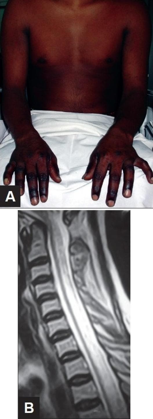 This composite figure demonstrates clinical and diagnostic findings associated with Vitamin B12 deficiency (Subacute Combined Degeneration of the spinal cord).
Image A is a clinical photograph of an 18-year-old male showing significant cutaneous hyperpigmentation of the distal upper extremities. The darkening is most pronounced on the dorsal surfaces of the hands and fingers, contrasting with the lighter skin tone of the proximal arms and chest. This is a common dermatologic manifestation of megaloblastic anemia.
Image B is a sagittal T2-weighted MRI of the cervical and upper thoracic spine. It reveals a long-segment, linear intramedullary hyperintense signal within the posterior aspect of the spinal cord. This finding represents edema and demyelination characteristic of Subacute Combined Degeneration, which typically affects the posterior and lateral columns while sparing the anterior column. The combination of these visual findings—distal hyperpigmentation and longitudinal posterior cord hyperintensity—is highly suggestive of severe Vitamin B12 deficiency in the context of progressive paraplegia.