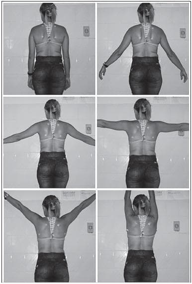 A series of six clinical photographs in black and white, capturing a posterior view of a human subject to demonstrate scapular kinematics during shoulder abduction. The sequence displays progressive bilateral arm abduction in the frontal plane at standardized intervals: 0 degrees (pendant position), 30 degrees, 60 degrees, 90 degrees, 120 degrees, and maximum abduction (approximately 170-180 degrees). Anatomical surface markers are visible on the subject's back, specifically positioned at the superior and inferior angles of the scapulae to facilitate biophotogrammetry analysis. The images illustrate the scapulohumeral rhythm, showing the upward and lateral rotation of the scapula as the humerus is elevated. This clinical imaging series is typical for orthopedic or physical therapy assessments of scapular dyskinesis, shoulder range of motion, and biomechanical studies of the shoulder complex.