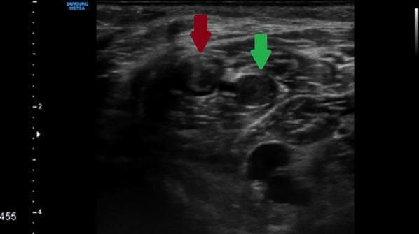 This diagnostic image is a grayscale B-mode ultrasound of the calf in a transverse plane, demonstrating gastrocnemius vein thrombosis. The image highlights two adjacent gastrocnemius veins, indicated by red and green arrows. Both vessels exhibit characteristic signs of Deep Vein Thrombosis (DVT), primarily the presence of internal echogenic material filling the lumens, which should normally appear anechoic (black). The vein on the left (red arrow) shows more distinct, brighter echogenic content compared to the vein on the right (green arrow), which appears slightly more heterogeneous. The surrounding musculature of the calf is visible, providing anatomical context. This visual is a classic educational example used to teach diagnostic criteria for venous thrombosis, emphasizing the identification of intraluminal echoes and increased vessel diameter as indicators of an occlusive or semi-occlusive thrombus.