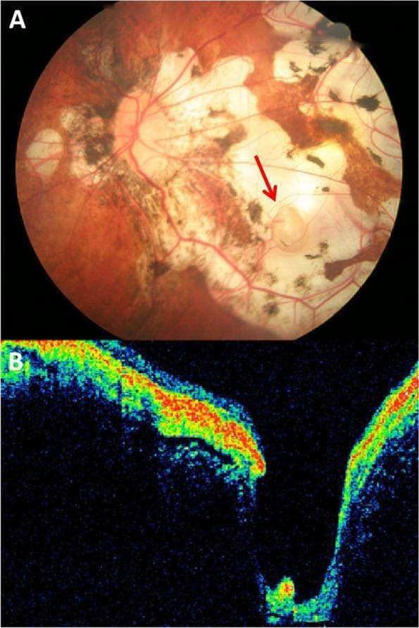 This medical image displays findings from a 62-year-old patient with pathological myopia and metamorphopsia. Panel A is a color fundus photograph showing severe myopic retinal degeneration. Key features include extensive chorioretinal atrophy, choroidal lacquer cracks, and marked retinal thinning, exposing the white underlying sclera. A red arrow identifies a Macular Scleral Pit (MSP) located inferotemporally to the macula. This MSP is a well-demarcated, oval, gray-white lesion approximately one optic disc diameter in size, with linear retinal vessels visible across its base. Panel B is a cross-sectional Optical Coherence Tomography (OCT) scan corresponding to the lesion. It reveals a deep, crater-like excavation that extends through the thinned retina and choroid into the sclera. The OCT shows a sharp depression located approximately 30 ̀̀m from the fovea centralis. There is a focal area of hyperintensity at the base of the pit beneath the neurosensory retina, though no active neurosensory detachment or defects are observed. These findings illustrate the structural complications associated with axial elongation in high myopia.