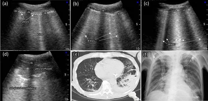 A multi-modal comparison of thoracic imaging findings in aspiration pneumonia, featuring point-of-care ultrasound (POCUS), computed tomography (CT), and chest X-ray (CXR). Panels (a)-(d) demonstrate a spectrum of lung ultrasound findings: (a) shows a single vertical B-line artifact originating from the pleural line; (b) displays multiple (≥3) B-lines; (c) shows confluent (≥5) B-lines creating a 'white lung' appearance; and (d) identifies sub-pleural consolidation (a hypoechoic area) and adjacent pleural effusion. Panel (e) is an axial CT scan of the chest showing significant consolidation and air bronchograms in the left lung, typical of aspiration pneumonia. Panel (f) is a posterior-anterior chest radiograph from the same patient, illustrating a loss of the silhouette of the left diaphragmatic arch behind the heart, indicating left lower lobe pathology. The collection serves as an educational comparison of diagnostic modalities for identifying pulmonary edema, interstitial syndrome, and consolidation in a clinical setting.
