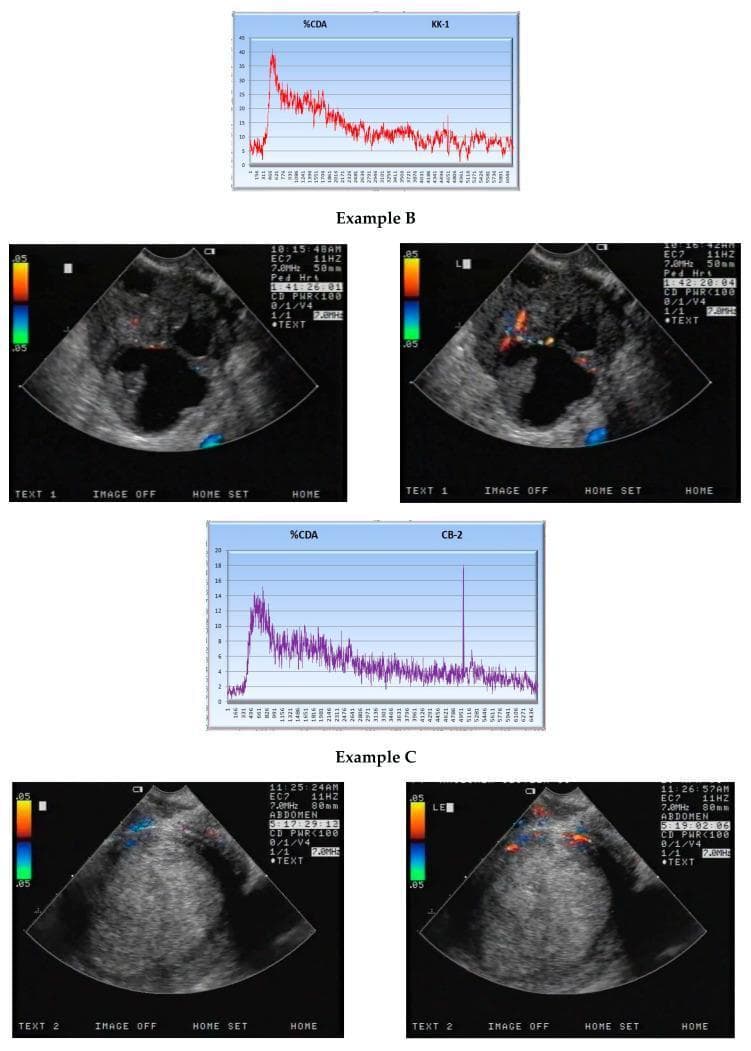 Contrast-Enhanced Ultrasound (CEUS) comparison panels illustrating diagnostic features of malignant versus benign lesions. The image is divided into Example B (malignant) and Example C (benign). Each panel consists of a quantitative %CDA (Computerized Digital Analysis) time-intensity curve above dual-view ultrasound images showing pre-contrast and peak enhancement phases. Example B (top) displays a malignant lesion with a high-amplitude %CDA curve reaching a peak (Ymax) near 40 units, characterized by an aggressive washout phase; the corresponding sonograms show heterogeneous peripheral enhancement. Example C (bottom) displays a benign lesion with a significantly lower %CDA peak (Ymax) near 14 units and a more stable, lower-intensity enhancement pattern. The ultrasound displays include technical parameters: 7.0 MHz frequency, 50-80mm depth, and CD PWR < 100. This graphic demonstrates the clinical utility of quantitative CEUS analysis in differentiating tumor pathology based on vascular perfusion kinetics and contrast agent distribution over time.