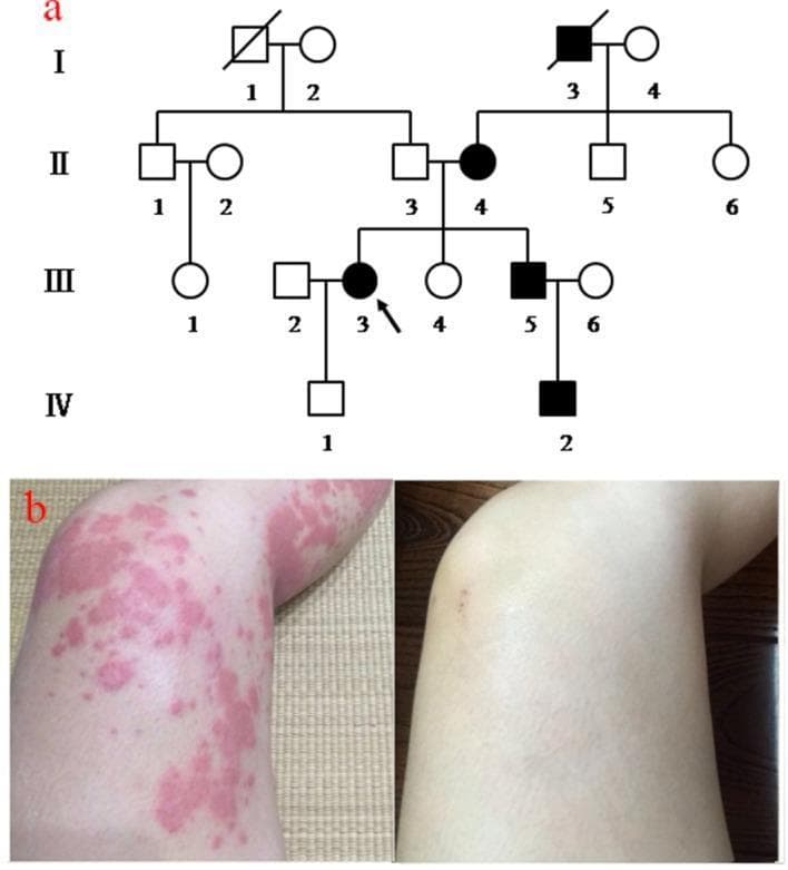 This composite educational image illustrates Familial Cold Autoinflammatory Syndrome (FCAS) through genetic and clinical data. Panel (a) presents a four-generation pedigree chart demonstrating an autosomal dominant inheritance pattern. Standard nomenclature is used: squares represent males, circles represent females, and black filled symbols denote individuals affected by FCAS. A diagonal line indicates deceased members, and the proband is identified with an arrow at III-3. Panel (b) provides a side-by-side clinical comparison of the patient's skin on the lower limbs. The left photograph shows cold-induced urticaria following 30 minutes of exposure to 4°C. The skin exhibits diffuse, erythematous, edematous plaques and papules (wheals) with irregular, coalescing borders across the knee and thigh. The right photograph shows the same anatomical region at room temperature, demonstrating complete resolution of the rash with normal skin texture and pigmentation. This visual supports the diagnosis of cold-induced urticarial-like rashes typical of NLRP12-related autoinflammatory disorders.