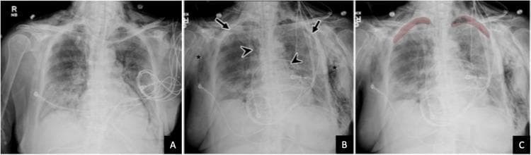 A comparison of three anteroposterior (AP) chest radiographs demonstrating the progression of pulmonary pathology and the application of diagnostic AI. Image A shows a baseline with bilateral, patchy airspace opacities predominantly in the lower lung zones, typical of multifocal pneumonia (e.g., COVID-19). Image B, a follow-up radiograph, reveals significant complications of barotrauma: subtle biapical pneumothoraces (arrows), pneumomediastinum indicated by lucent air streaks outlining the mediastinal borders (arrowheads), and extensive bilateral subcutaneous emphysema manifesting as radiolucent air dissecting through the chest wall soft tissues (asterisks). Image C displays the same follow-up radiograph with an artificial intelligence (AI) overlay, highlighting the detected biapical pneumothoraces in red for prioritized clinical review. The series illustrates critical care radiology findings, including pulmonary consolidation, extra-alveolar air collections, and the role of computer-aided detection (CAD) in identifying subtle but life-threatening conditions in ICU patients.