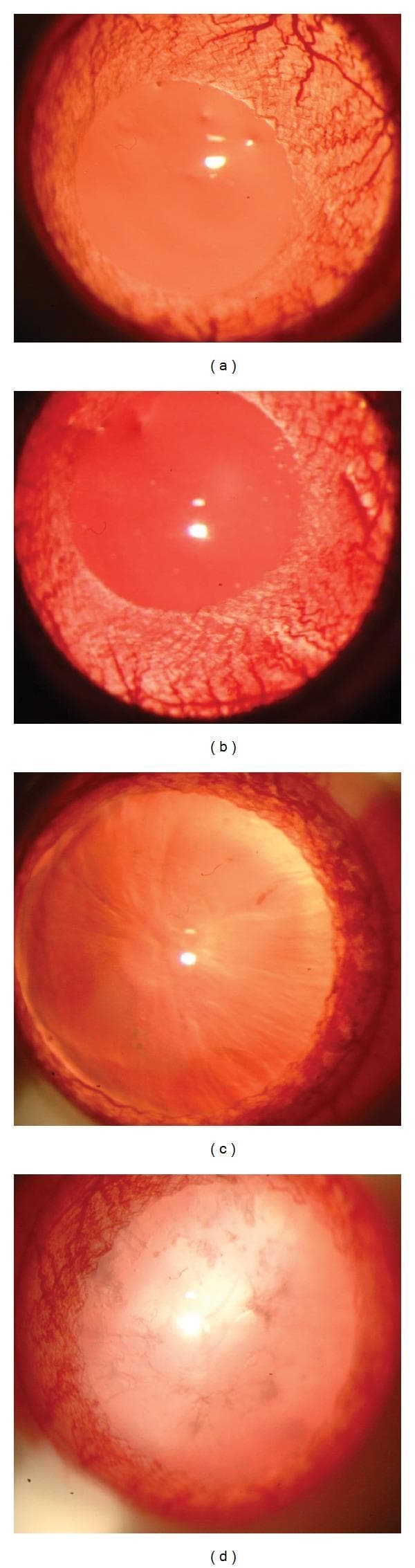 This set of clinical photographs presents a side-by-side comparison of crystalline lenses using slit-lamp biomicroscopy to illustrate cataract progression in various experimental conditions. The series is divided into four panels: (a) Control, (b) Nicotine-treated, (c) Diabetic, and (d) Nicotine-treated diabetic. Panels (a) and (b) demonstrate normal lens clarity with high transparency and an absence of opacification, categorized as Grade 0 on the Oxford classification system. In contrast, panel (c) shows the early stages of diabetic cataract, characterized by mild nuclear opacity and increasingly prominent lens sutures. Panel (d) displays advanced pathological changes in the nicotine-treated diabetic subject, featuring significant and dense nuclear opacification that obscures internal lens structures and causes scattered light reflection. These images serve as educational visual aids for understanding the pathophysiology of cataracts, specifically highlighting how metabolic stressors like diabetes, potentially exacerbated by nicotine, accelerate lens opacification and alter lens morphology.