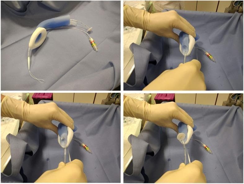A four-panel sequence of intraoperative clinical photographs demonstrating the use of the LMA Gastro™ supraglottic airway device during a percutaneous endoscopic gastrostomy (PEG) procedure. The top-left image shows the standalone device on a sterile blue surgical drape, highlighting its dual-channel design: a curved airway tube and a secondary, wide-bore gastric channel intended for endoscopic access. Key components visible include the inflatable distal cuff, an integrated proximal bite block, and two pilot balloon inflation lines with color-coded connectors. The remaining three panels show a healthcare provider’s gloved hands manipulating the device to demonstrate the 'pull' technique. A white gastroduodenoscope or pull-wire is shown being threaded through the large gastric channel of the LMA. This visual illustrates the device's utility in providing simultaneous positive pressure ventilation and unhindered endoscopic access to the upper gastrointestinal tract, facilitating advanced procedures like PEG in patients under general anesthesia.