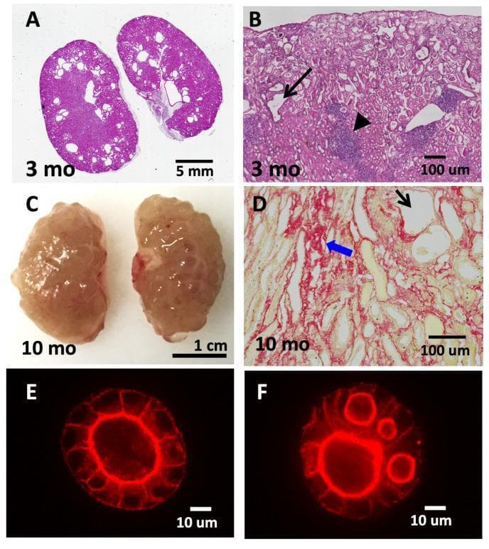This composite figure illustrates the progression of cystic kidney disease in Tns1-knockout (KO) models through clinical photography, light microscopy, and cell culture. Panel A (H&E stain) shows whole-kidney cross-sections from a 3-month-old mouse with early tubular dilatations. Panel B provides a higher magnification (100 µm scale) of the 3-month-old tissue, highlighting dilated tubules (black arrow) and interstitial leukocyte infiltration (arrowhead). Panel C displays gross morphology of 10-month-old kidneys, exhibiting a pale, bosselated surface with multiple prominent cysts. Panel D (Sirius Red stain) reveals significant interstitial fibrosis (blue arrow) and severe tubular lumen expansion (black arrow) at 10 months. Panels E and F compare wild-type (WT) and Tns1-KO MDCK cells in 3D Matrigel culture stained for actin (red); while WT cells form a single, polarized lumen, Tns1-KO cells exhibit a multi-lumen phenotype. This figure demonstrates how Tns1 deficiency leads to progressive renal structural deterioration, including fibrosis and cystogenesis, serving as an educational model for recessive cystic kidney disease pathology.