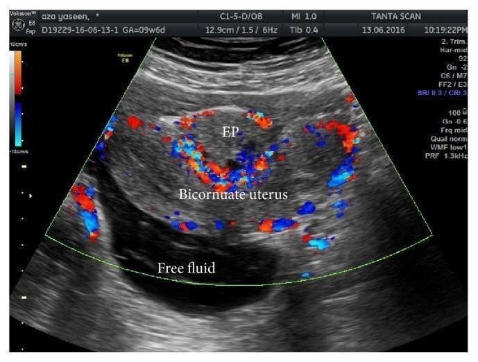 This color Doppler ultrasound image illustrates a complex gynecological presentation involving a bicornuate uterus and an ectopic pregnancy (EP). The transabdominal scan reveals the distinct morphology of the bicornuate uterus, characterized by two separate uterine horns. Positioned centrally between these horns is a gestational sac labeled as 'EP'. A classic 'Ring of Fire' sign is visible—a dense circumferential pattern of red and blue color Doppler signals surrounding the ectopic sac, which indicates hypervascularity and active trophoblastic peripheral blood flow. In the dependent portion of the pelvic cavity, a significant anechoic (dark) area is labeled as 'Free fluid', suggesting hemoperitoneum or inflammatory exudate in the context of a ruptured or leaking ectopic pregnancy. This diagnostic image is highly clinically significant for demonstrating uterine anomalies, the ultrasound signs of extrauterine gestation, and associated complications like pelvic fluid accumulation, which are critical concepts in emergency obstetrics and radiology.