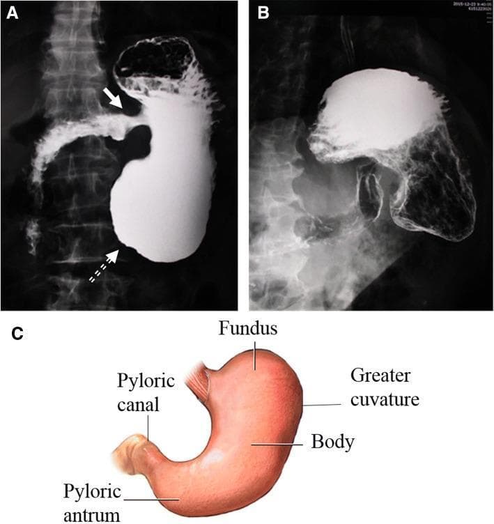 This composite figure presents a double-contrast upper gastrointestinal series compared to normal gastric anatomy, demonstrating significant structural distortion. Panel A shows a contrast-enhanced stomach with a shortened long axis and an enlarged distal antrum (dashed arrow), creating a distinctive 'hammer' shape. The pylorus is malpositioned, opening abnormally toward the side of the lesser curvature (solid arrow). Fluid accumulation is evident within the gastric lumen. Panel B highlights the gastric mucosa using double-contrast technique, revealing a 'bilateral sign' along the lesser curvature characterized by a fixed, irregular contour and mucosal absence in the gastric antrum, suggestive of localized pathology such as a large ulcer. Panel C provides a labeled anatomical diagram of a normal stomach (fundus, body, greater curvature, pyloric antrum, and pyloric canal) for morphological comparison. These findings illustrate complex gastric dysmotility or congenital malformation (such as organoaxial volvulus or malrotation) and secondary mucosal lesions. The content is suitable for educational use in gastroenterology and radiology focusing on contrast imaging interpretation.