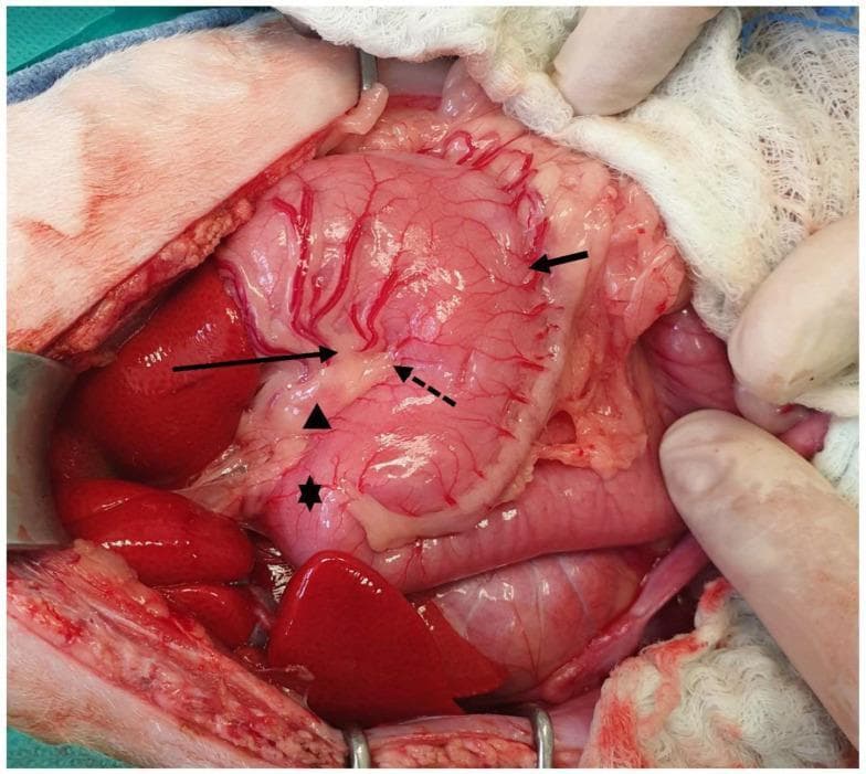 This clinical intraoperative photograph displays the macro-anatomical features of the stomach during an abdominal surgical procedure. The stomach is oriented with the cranial aspect (head) toward the left of the frame. Key anatomical landmarks are identified: the lesser curvature is indicated by a long solid arrow on the concave side, while the greater curvature is marked by a short arrow on the convex side. A distinct angular notch (incisura angularis) is visible along the lesser curvature, denoted by a dashed arrow, serving as a boundary between the gastric body and the pyloric part. The pylorus itself is marked with an asterisk (*). A gastric lymph node is localized along the lesser curvature, indicated by an arrowhead. The stomach's surface exhibits a rich vascular network of branching blood vessels. Surrounding visceral structures, including liver lobes and intestinal segments, are visible within the surgical field, which is maintained by retractors and surgical gauze. This image serves as an educational reference for gastric anatomy, vascularization, and landmark identification during laparotomy.