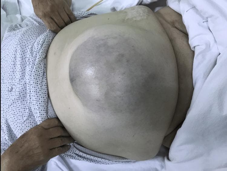 Clinical photograph showing an anterior view of an 80-year-old female patient with a giant, irreducible umbilical hernia. The abdomen is significantly distended, featuring a large, protruding mass approximately 18x18 cm located in the umbilical and infraumbilical regions. The most prominent clinical sign is the diffuse, bluish-purple discoloration of the skin overlying the central aspect of the hernia sac. This cyanotic appearance is highly suggestive of vascular compromise, strangulation, or underlying gangrene of the incarcerated bowel contents. The surrounding abdominal skin is pale but intact, without visible ulceration. This image serves as a critical educational example of an 'acute abdomen' presentation where skin color changes over a hernia site indicate a surgical emergency, necessitating urgent intervention to prevent or address bowel necrosis.