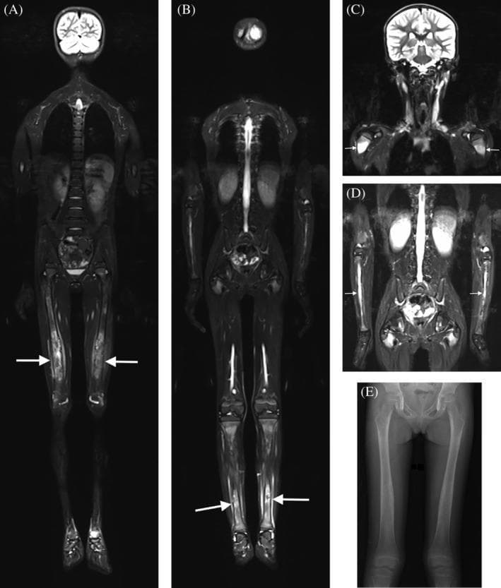 This composite diagnostic image showcases imaging findings of Camurati-Engelmann disease in a pediatric patient. Panels A-D present Whole-Body Short Tau Inversion Recovery (STIR) Magnetic Resonance Imaging (MRI) in the coronal plane. These scans demonstrate bilateral, symmetrical hyperintense signal intensity (edema) within the bone marrow of the diaphyses and metadiaphyseal regions of the femur (A), tibia (B), humerus (C), and radius/ulna (D). The pathology is characterized by concentric cortical thickening, surface irregularities, and fusiform diaphyseal enlargement. Notably, the epiphyseal regions are consistently spared across all long bones, and there is an absence of restricted diffusion. Panel E provides a corresponding clinical radiograph (X-ray) of the femurs, illustrating the radiographic correlate of slight fusiform cortical thickening along the femoral shafts. The findings are pathognomonic for progressive diaphyseal dysplasia, highlighting the characteristic symmetrical long bone involvement and sparing of the joints.