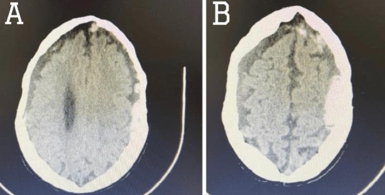 Two side-by-side axial sections of a non-contrast CT scan of the brain, demonstrating bilateral extra-axial fluid collections. Image (A) shows a hyperdense, crescent-shaped collection along the frontoparietal region, characteristic of an acute subdural hematoma (SDH). There is evidence of mild mass effect with compression of the underlying brain parenchyma and minimal midline shift. Image (B) demonstrates a contralateral collection that appears hypodense relative to acute blood, consistent with a chronic subdural hematoma. Additionally, focal areas of hyperdensity are visible within the sulci, indicating associated convexity subarachnoid hemorrhage (cSAH). These images serve as a clinical comparison of blood density at different stages of evolution (acute vs. chronic) within the subdural space. The diagnostic focus is on intracranial hemorrhage identification, mass effect evaluation, and the assessment of trauma-related or spontaneous vascular complications in a neuroradiological context.