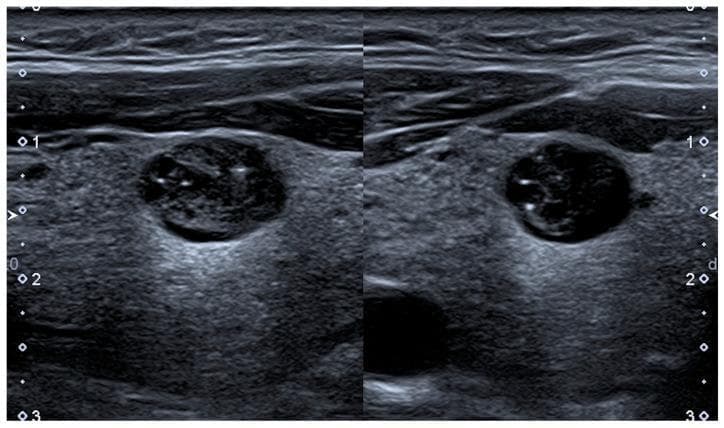 Diagnostic ultrasound of the thyroid gland showing a solitary thyroid nodule in both longitudinal (left) and transverse (right) planes. The nodule is oval-shaped, measuring approximately 11 x 9 x 7 mm, with a primarily isoechoic background relative to the surrounding thyroid parenchyma. It exhibits a mixed internal composition characterized by multiple microcystic cavities (hypoechoic/anechoic areas). Within these cavities, punctate hyperechoic spots are visible, specifically located at the posterior aspect or 'bottom' of the cystic spaces, which can represent concentrated colloid or microcalcifications. The image is an educational example of Thyroid Imaging and Reporting Data System (TIRADS) risk stratification, demonstrating features that may be classified differently across systems (e.g., ACR-TIRADS 4, EU-TIRADS 3, K-TIRADS 4). The presence of mixed solid-cystic components and hyperechoic foci are key parameters in determining the malignancy risk of thyroid nodules in clinical practice.