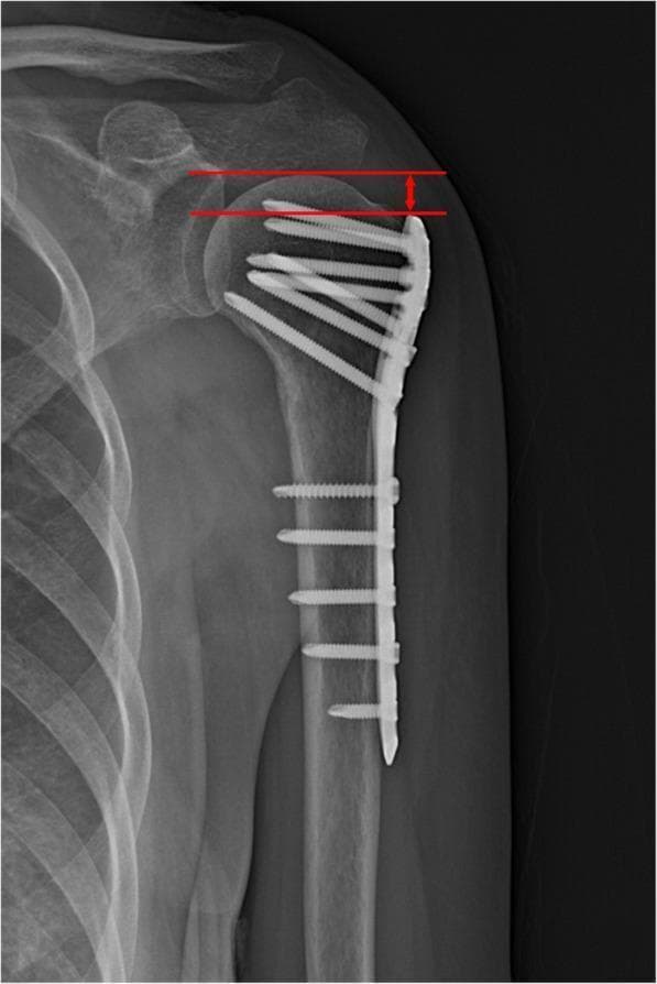 Anteroposterior (AP) x-ray of the shoulder demonstrating a proximal humerus fracture treated with internal fixation. A metallic locking compression plate (LCP) is positioned on the lateral aspect of the humeral shaft, extending superiorly to the greater tuberosity. The construct features multiple locking screws: proximal screws are oriented at varying angles to support the humeral head subchondral bone, while distal screws are inserted perpendicularly into the humeral diaphysis. Educational annotations in red illustrate the methodology for measuring Humeral Head Height (HHH). Two parallel horizontal lines are drawn: the superior line identifies the highest point of the humeral head articular surface, and the inferior line aligns with the top edge of the orthopedic plate. A double-headed vertical arrow indicates the distance between these lines, used clinically to monitor for postoperative loss of fixation or subsidence of the humeral head. The image provides a clear demonstration of orthopedic implant positioning and radiographic assessment parameters for proximal humeral fractures.