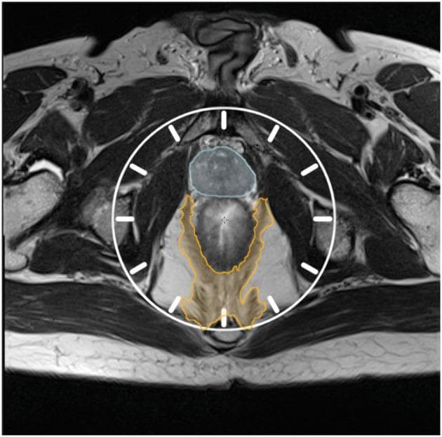 This diagnostic image is an axial T2-weighted MRI of the male pelvis, focusing on the rectal and perirectal anatomy. To facilitate standardized localization, a clock face overlay is centered on the mesorectum. The prostate gland is highlighted with blue hatching in the anterior compartment, corresponding to the 10 o'clock to 2 o'clock positions. Posteriorly, the pelvic diaphragm (levator ani and coccygeal muscles) is delineated with orange hatching, primarily occupying the posterior quadrants between the 3 o'clock and 9 o'clock positions. The image serves as an educational anatomical template for describing tumor location and surgical planes, particularly for extralevator abdominoperineal excision (ELAPE). Surrounding structures include the gluteal musculature, ischial tuberosities, and femoral heads, providing anatomical context for surgical oncology planning and postoperative assessment of the residual pelvic diaphragm.