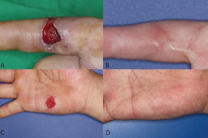 Clinical photograph series demonstrating the progression and outcomes of a conventional split-thickness skin graft (STSG) for a hand injury. The four-panel figure illustrates both the recipient and donor sites at different stages. Panel A shows a preoperative view of a full-thickness skin defect on the volar aspect of a finger, characterized by an open wound with visible deep red granulation tissue. Panel B displays the same recipient site at 6 months postoperatively, showing a well-healed graft with minimal scarring and good tissue integration. Panel C depicts the donor site on the hypothenar eminence of the palm at postoperative day 5, presenting as a raw, erythematous area following graft harvest. Panel D shows the donor site at 6 months postoperatively, demonstrating complete epithelialization with slight hyperpigmentation and texture changes consistent with a mature scar. This image set serves as an educational reference for plastic and reconstructive surgery, highlighting surgical wound healing, graft take, and long-term aesthetic outcomes in hand surgery.