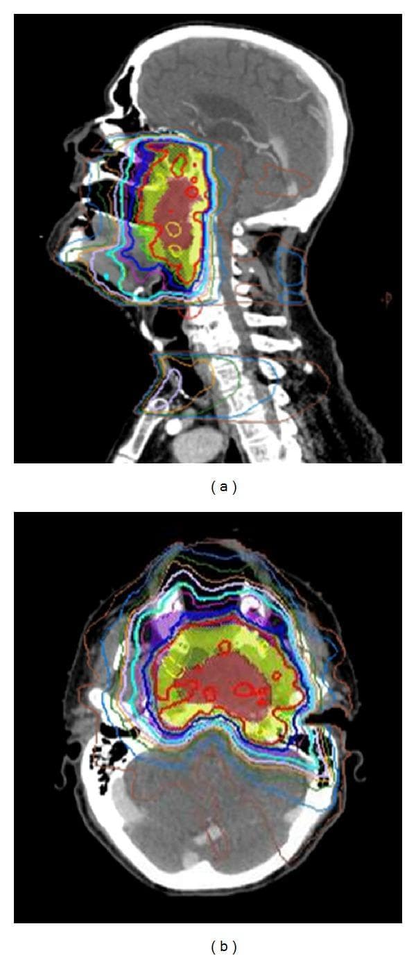 This diagnostic image displays a radiotherapy treatment plan for locally advanced nasopharyngeal cancer using Intensity-Modulated Radiation Therapy (IMRT). The visual consists of two panels: (a) a sagittal CT view and (b) an axial CT view of the head and neck. Overlaid on the anatomical structures are color-coded isodose lines representing radiation dose distribution. The highest dose regions (target volumes) are indicated by red and yellow areas, concentrated around the nasopharynx, skull base, and clivus. A sharp dose gradient is visible as the colors transition through green, blue, and cyan, reflecting rapid dose fall-off. This planning demonstrates the precision of IMRT in conforming high-dose radiation to the primary tumor while sparing adjacent critical 'organs at risk' (OARs), including the brainstem, spinal cord, and temporal lobes. The images highlight the clinical importance of high-resolution computerized planning and daily alignment (such as CBCT) to ensure target coverage and minimize toxicity to neuro-anatomical structures in head and neck squamous cell carcinoma (HNSCC) treatment.