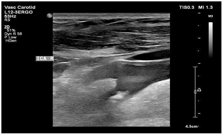 This diagnostic B-mode ultrasound image displays a longitudinal view of the right internal carotid artery (ICA). The image captures a significant atherosclerotic plaque characterized by heterogeneous echogenicity, containing both hyperechoic (bright) and hypoechoic (dark) regions. A prominent feature is the presence of a distinct acoustic shadow extending distally from the plaque, which indicates localized areas of dense calcification that reflect or absorb the ultrasound signal. This type of 'hard' or calcified plaque is often associated with more advanced stages of atherosclerosis. The image illustrates key diagnostic criteria used in vascular neurology and radiology to assess plaque stability and the risk of ischemic events, such as Gray Scale Median (GSM) evaluation. The anatomical region is clearly labeled 'ICA R', and the scan provides a clinical representation of carotid artery stenosis suitable for medical education in cardiovascular pathology and non-invasive diagnostic imaging.