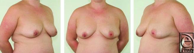 Clinical photograph set showing preoperative anterior and bilateral oblique views of a 38-year-old female patient's torso. The images demonstrate bilateral Grade 2 breast ptosis, characterized by the nipple-areola complex (NAC) positioned at or slightly below the level of the inframammary fold. Significant breast asymmetry is visible; the right breast exhibits post-surgical distortion with a flattened, less projected nipple and altered contour compared to the left. The patient has a history of multiple duct excision procedures for recurrent periductal mastitis and fistula formation, primarily affecting the right side. The lateral views highlight the downward slope of the breast tissue and the conical shape typical of secondary ptosis. Skin texture is largely intact, though surgical scarring and nipple retraction are evident on the right. This visual serves as a primary assessment for plastic and reconstructive surgery, specifically for evaluating volume, symmetry, and NAC position prior to potential mastopexy or breast reconstruction.