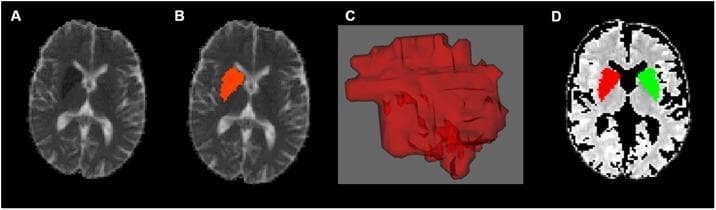 This composite diagnostic image illustrates the process of defining a Volume of Interest (VOI) for an acute ischemic stroke using neuroimaging. Panel A shows an axial slice of a diffusion-weighted MRI (DWI) displaying a hyperintense lesion in the region of the basal ganglia, consistent with an acute infarct. Panel B demonstrates the manual segmentation of this infarct, highlighted as a red Region of Interest (ROI). Panel C presents a 3D reconstruction of the segmented infarct volume, providing a volumetric representation of the lesion. Panel D shows an axial map (likely an Apparent Diffusion Coefficient or Fractional Anisotropy map) with two mirrored ROIs: the primary infarct site in the left hemisphere (red) and its anatomically mirrored counterpart in the unaffected right hemisphere (green). This methodology is used in neuroradiology research to compare diffusion parameters between ischemic and healthy brain tissue, excluding cerebrospinal fluid (CSF) to ensure data accuracy. The image is intended for advanced medical education regarding stroke imaging analysis and neuroimaging post-processing techniques.