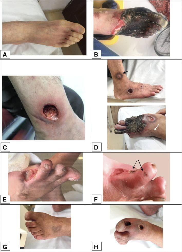A composite of clinical photographs (panels A-H) demonstrating various stages of dermal gangrene and chronic ulceration in the lower extremities of patients with thromboangiitis obliterans (Buerger’s disease). Panel A shows initial pallor and Raynaud's phenomenon. Panel B illustrates extensive, dark necrotic tissue covering the forefoot and toes with a sharp demarcating border and surrounding erythema. Panel C depicts a deep, circular 'punched-out' ulcer on the lower leg with visible granulation tissue and peripheral edema. Panel D shows multifocal purpuric-like lesions progressing to localized gangrene on the dorsum of the foot and distal digits. Panels E and F provide close-up views of digital ulcers and small gangrenous papules (indicated by arrows) on an amputation stump. Panels G and H show the evolution of localized gangrenous lesions on the toes, transitioning from active necrosis to a dryer, more localized state. This collection highlights the microvascular complications of TAO, including tissue ischemia, necrosis, and subsequent ulceration despite angiogenic medical therapies.