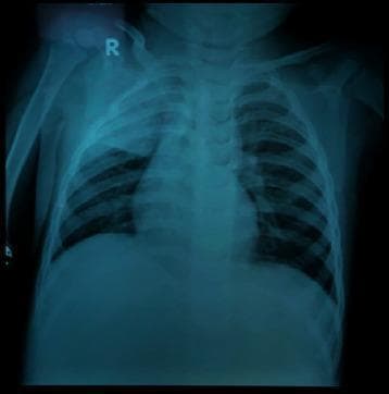 This diagnostic image is a posterior-anterior (PA) pediatric chest X-ray. The primary finding is a dense, homogeneous opacity located in the right upper lobe, characterized by a well-defined inferior border along the minor fissure, which is highly consistent with lobar consolidation. Bilateral perihilar and parenchymal spotting (reticulonodular opacities) are also visible, suggesting an associated bronchopneumonia component. The cardiac silhouette and mediastinal structures appear within normal limits for a pediatric patient, though the bony structures of the rib cage and vertebrae are visible with moderate clarity. This imaging demonstrates typical radiological signs of community-acquired or atypical pneumonia, such as right superior lobar pneumonia. Clinically, this serves as an educational example of differentiating focal lobar consolidation from generalized patchy bronchopneumonia patterns in a pediatric context.