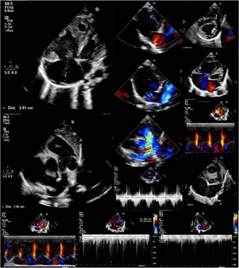 This diagnostic composite displays multiple echocardiography modalities, including 2D grayscale, color Doppler, and spectral Doppler (M-mode and pulse wave) views of a pediatric heart. The grayscale images show structural abnormalities characterized by biventricular hypertrophy and significant chamber enlargement. Visible septal discontinuities confirm a large atrial septal defect (ASD) measuring approximately 16mm and a muscular ventricular septal defect (VSD). Color Doppler imaging demonstrates complex, turbulent hemodynamic patterns with high-velocity mosaic signals indicating bidirectional (primarily left-to-right) shunting at the atrial and ventricular levels. Signs of mild-to-moderate tricuspid and mild mitral regurgitation are evident via reflux jets across the valvular planes. Spectral Doppler waveforms facilitate the assessment of pulmonary hypertension and abnormal flow velocities. The comprehensive imaging supports a diagnosis of multi-defect congenital heart disease often associated with syndromic presentations like OFCD. These views are essential for pediatric cardiology students to identify pathological shunting, valvular insufficiency, and secondary structural changes like hypertrophy.