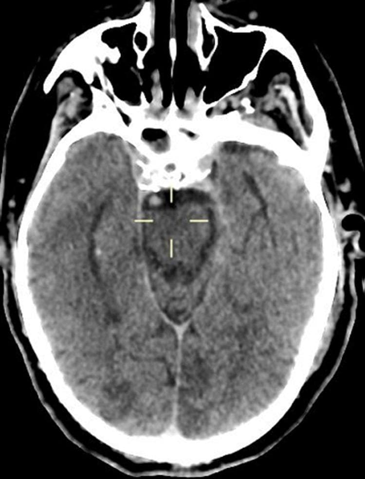 This diagnostic image is an axial non-contrast computed tomography (CT) scan of the brain. The scan reveals multiple areas of abnormal hypodensity located in the cortical and subcortical regions. These hypodense lesions are distributed bilaterally, predominantly involving the parietal and occipital lobes. The density of these areas is lower than that of the surrounding healthy brain parenchyma, which is characteristic of acute or subacute cerebral infarction. Anatomically, the image demonstrates the brain parenchyma, the midbrain/pons junction, and parts of the sphenoid sinus and orbits anteriorly. The falx cerebri is visible along the midline posteriorly. This finding is consistent with multifocal strokes, likely secondary to a systemic hypercoagulable state or cardioembolic event. The image serves as an educational example of identifying ischemic territories and evaluating bilateral cerebrovascular accidents in a critical care or emergency setting.