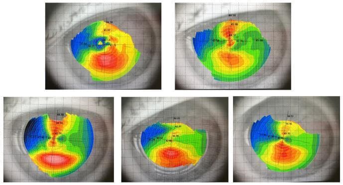 A compilation of five Placido disc-based corneal topography maps illustrating the variability in corneal curvature and surface regularity. The diagnostic images display color-coded dioptric power maps overlaid on the anterior segment of the human eye. The color scale uses a standard cooling/warming spectrum: blue and green represent flatter peripheral areas, while yellow, orange, and red represent areas of steeper curvature, typically concentrated centrally or inferiorly. The maps exhibit various patterns, including asymmetric bowties and irregular steepening, which are clinically significant in the screening and diagnosis of corneal ectasias like keratoconus. A fine grid is superimposed over each map, where the distortion of the grid lines correlates with rapid changes in surface topography and local irregular astigmatism. Quantitative values in diopters are visible as numeric annotations across the maps to facilitate precise clinical assessment of the corneal refractive power.