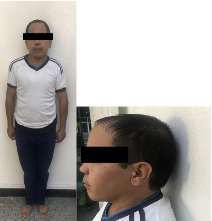 This composite clinical photograph presents a frontal full-body view and a lateral head profile of an adult male exhibiting classic features of Albright Hereditary Osteodystrophy (AHO). The frontal image demonstrates short stature and a stocky habitus with relatively proportional limbs. Key facial and cervical features include a noticeably rounded 'moon-shaped' face and a shortened neck. The lateral profile reveals mandibular protrusion (prognathism) and a slightly receding hairline. These visual findings are pathognomonic clinical markers often associated with pseudohypoparathyroidism or pseudopseudohypoparathyroidism. The images serve as an educational resource for identifying the phenotypic manifestations of GNAS gene mutations, emphasizing the importance of physical examination in endocrine and genetic diagnostic pathways.