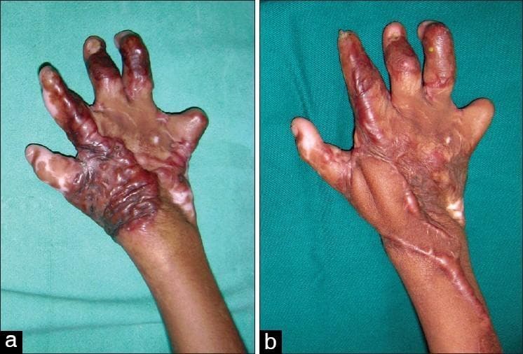 This clinical photograph comparison demonstrates the preoperative and postoperative states of a severe post-burn hand deformity in a pediatric patient. Image (a) shows a severe first-web space contracture with the thumb in a fixed adducted position. The skin exhibits extensive hypertrophic scarring, dark hyperpigmentation, and areas of hypopigmented patches, indicating deep thermal injury. The fingers also show signs of flexion deformities and scarring. Image (b) illustrates the hand following surgical intervention using a posterior interosseous flap. The first-web space has been successfully released, evidenced by the significantly improved abduction and pronation of the thumb. The surgical site is covered by a well-integrated skin flap that fills the previously contracted space. A longitudinal linear scar is visible on the dorsal forearm, corresponding to the flap harvest donor site. This comparison highlights the efficacy of regional flap reconstruction in restoring the functional anatomy of the thumb's range of motion and improving hand utility after severe burn contractures.