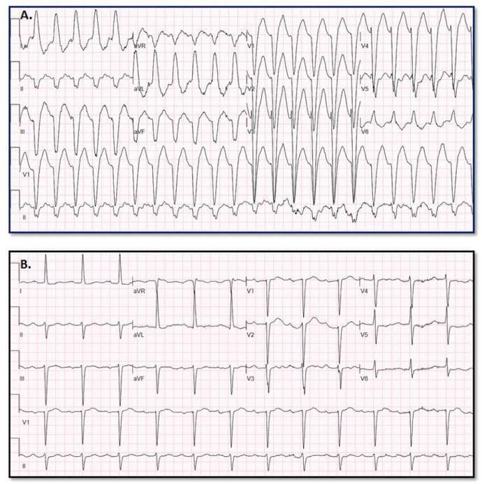 This diagnostic comparison image shows two 12-lead electrocardiograms (ECGs) used to illustrate the differentiation between Wide Complex Tachycardia (WCT) and baseline rhythms. Panel A displays a Wide Complex Tachycardia characterized by a rapid ventricular rate and significantly widened QRS complexes (approximately 170 ms). The morphology is relatively uniform with prominent S-waves in the precordial leads and notable baseline artifact. Panel B shows the patient's baseline ECG, presenting a narrow QRS complex rhythm with visible P-waves preceding each QRS, consistent with sinus rhythm or a supraventricular origin. The comparison highlights clinical diagnostic challenges where Supraventricular Tachycardia (SWCT) with aberrancy may mimic Ventricular Tachycardia (VT). This material is intended for advanced medical education in cardiology and electrophysiology, specifically focusing on ECG interpretation and the application of predictive models for arrhythmia classification.