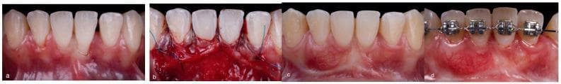 This sequence of four intraoral clinical photographs documents a periodontal mucogingival surgery for root coverage using a subepithelial connective tissue graft (SCTG) and a double lateral sliding bridge flap (DLSBF) technique on the mandibular anterior teeth. (a) Baseline: Shows significant gingival recession on the mandibular incisors with exposed root surfaces and thin biotype. (b) Immediate Postoperative: Displays the surgical site with a coronally repositioned flap covering the SCTG, secured with multiple black silk interrupted sutures; the tissue is erythematous and edematous, characteristic of immediate surgical trauma. (c) Four-Month Follow-Up: Shows successful root coverage with healthy, pink, keratinized gingiva and a stable mucogingival junction. (d) Two-Year Follow-Up: Demonstrates long-term stability of the gingival margin with a visible apical scar in the vestibule corresponding to the previous surgical incision. The patient is also undergoing active orthodontic treatment, indicated by fixed metal brackets and an archwire. This progression illustrates the surgical management of Cairo class recessions and the aesthetic integration of grafted tissue over time.