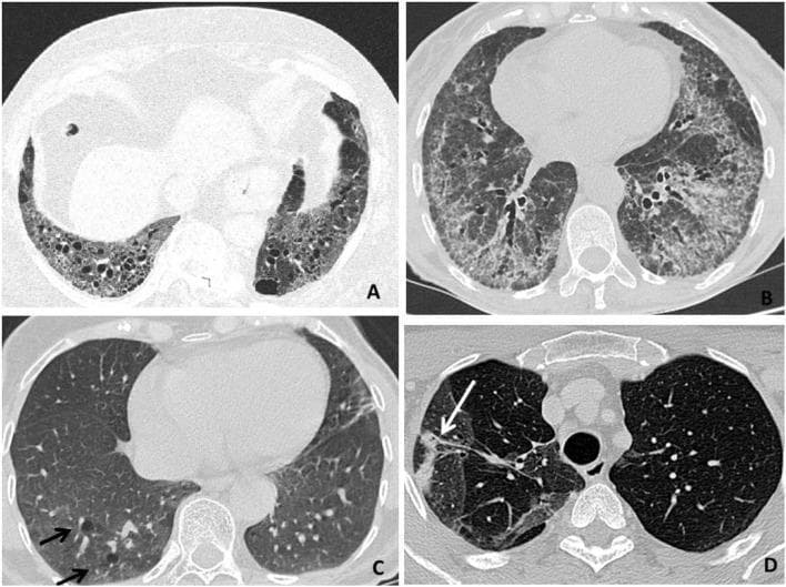 This composite of four axial high-resolution computed tomography (HRCT) scans illustrates various radiologic patterns of Rheumatoid Arthritis-associated Interstitial Lung Disease (RA-ILD). Panel A demonstrates a Usual Interstitial Pneumonia (UIP) pattern, characterized by bibasilar, subpleural honeycombing (clusters of cystic airspaces), reticular opacities, and traction bronchiectasis. Panel B displays a Nonspecific Interstitial Pneumonia (NSIP) pattern, showing diffuse, patchy ground-glass opacities and septal thickening with relative subpleural sparing. Panel C reveals a Lymphocytic Interstitial Pneumonia (LIP) pattern, highlighted by perivascular thin-walled lung cysts (indicated by black arrows). Panel D illustrates an Organizing Pneumonia (OP) pattern, featuring focal areas of parenchymal consolidation (indicated by a white arrow). These images serve as educational benchmarks for differentiating pulmonary manifestations in systemic autoimmune diseases. The radiological findings are critical for determining prognosis and guiding therapeutic strategies, such as distinguishing between predominantly fibrotic (UIP) versus inflammatory (NSIP/OP) processes.